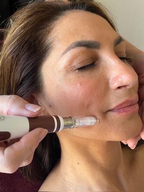 Professional Microneedling Behandlung im Kosmetikstudio Hürth